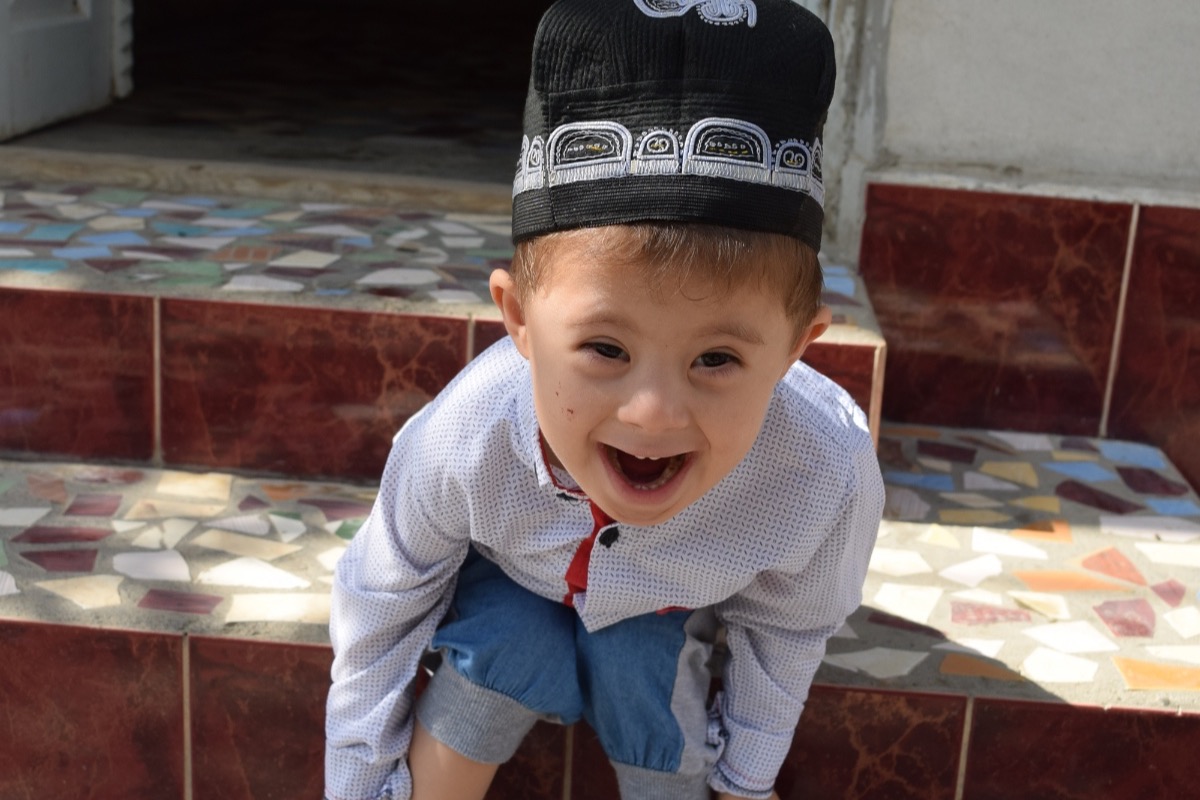 синдром дауна